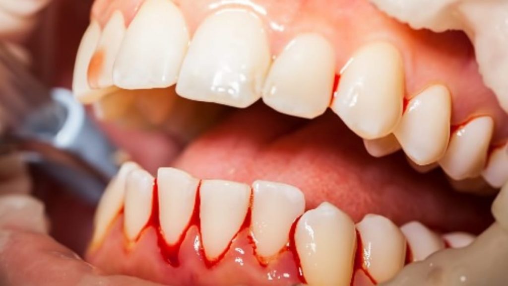 Bleeding Gums