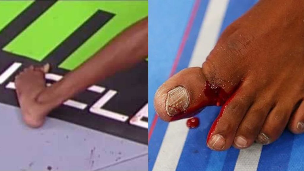 Jon Jones' broken toe against Chael Sonnen