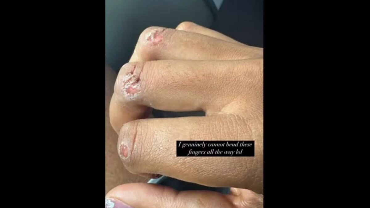 Naomi Osaka Reveals Brutal Injury She Suffered After Heartbreaking French Open Exit 1 Naomi Osaka's Instagram story