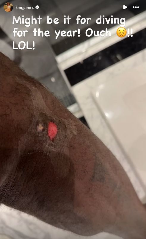 LeBron James showing off his scar